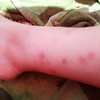 Fumigación o Desinsectación